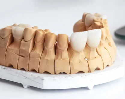 Beyond Aesthetics: The Functional Benefits of Dental Veneers