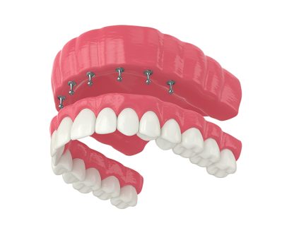 Everything You Need to Know About All-on-6 Dental Implants