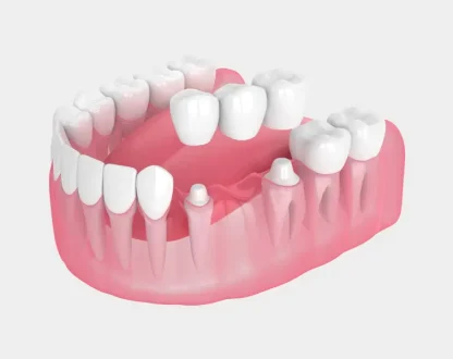 Addressing Common Concerns About Dental Bridges