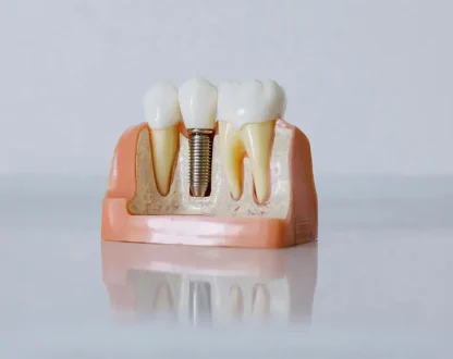 Are You a Candidate for Dental Implants? Factors That Affect Eligibility